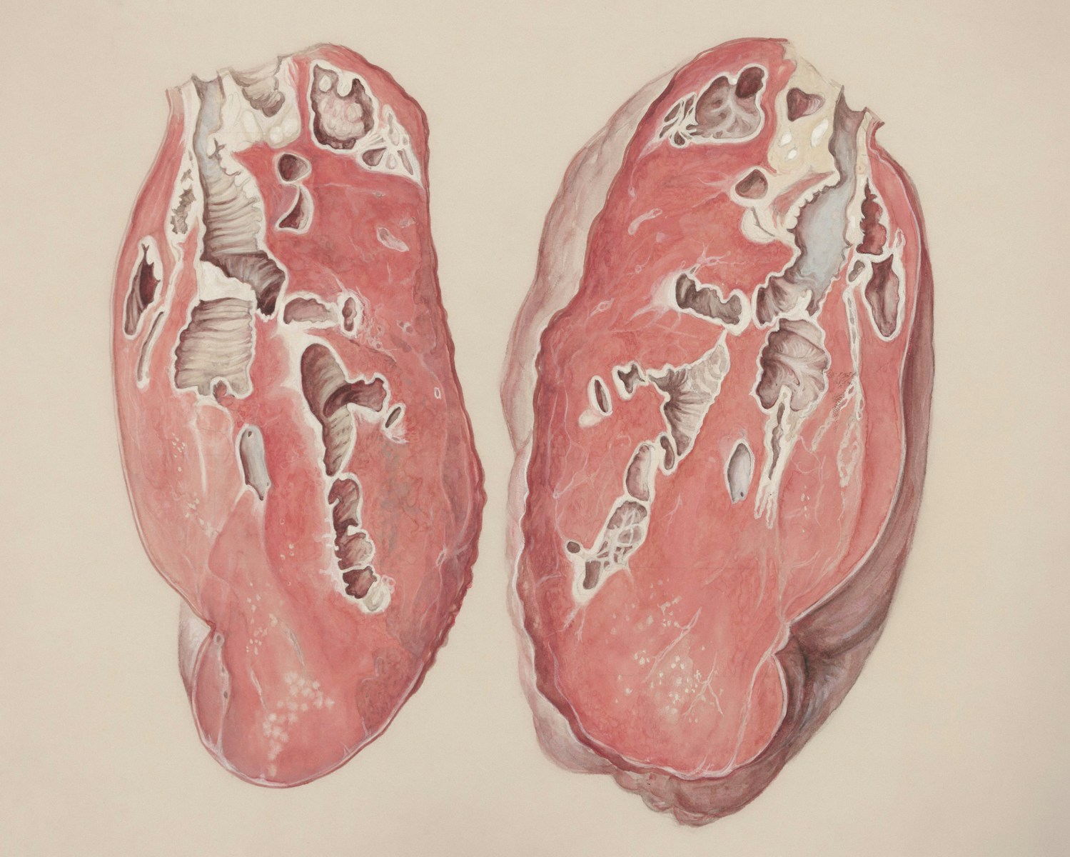 Sarcoidosis Unveiled: A Comprehensive Guide to Understanding This Complex Inflammatory Condition